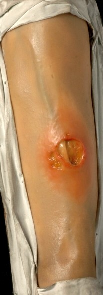 Syphilitic Gumma of the Leg